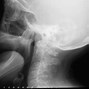 Image result for Jaw Bone Loss