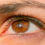 Image result for Eyelid Wart
