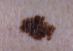 Image result for Melanoma Pictures Stage 1