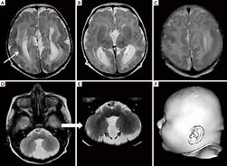Image result for Lissencephaly Type 1