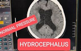 Image result for Normal Pressure Hydrocephalus CT