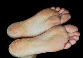 Image result for Dry Crusty Skin Between Toes