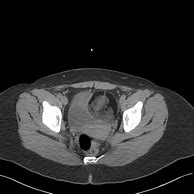 Image result for Largest Ovarian Tumor