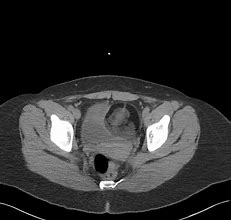 Image result for Large Tumor On Ovary