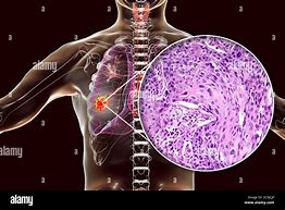 Image result for Microbiology Squamous Cell Carcinoma Lung