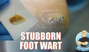 Image result for Wart Root Sticking Out