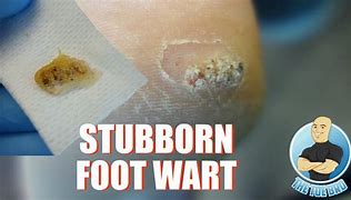 Image result for Deep Wart Removal
