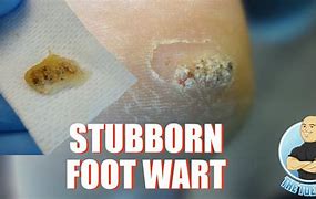 Image result for Deep Wart Removal