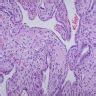 Image result for Intrauterine Fetal Death Placenta
