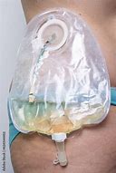 Image result for Nephrostomy Bag Urine
