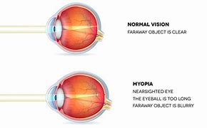 Image result for Myopia and Brain