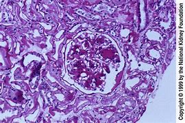 Image result for Diabetic Nephropathy Histology