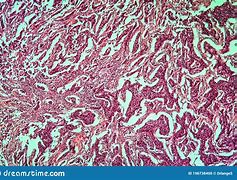 Image result for diseased tissue