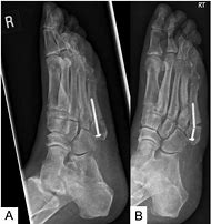 Image result for Jones Fracture