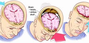 Image result for Cyst Concussion