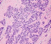 Image result for Desmoplastic Small Round Cell Tumor