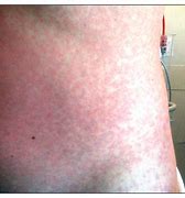 Image result for Flu Rash Symptoms