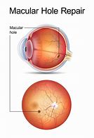 Image result for Hole in Retina