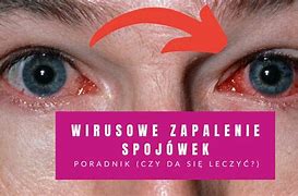 Image result for co_to_znaczy_zapalenie_woreczka_Łzowego