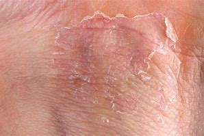Image result for Eczema in Genital Area