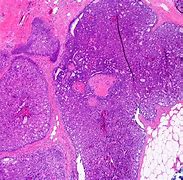 Image result for Papilloma Images