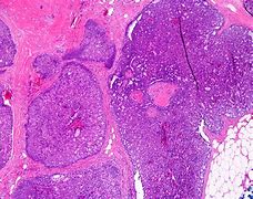 Image result for Conj Papilloma