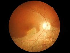 Image result for Macular Hole Vision