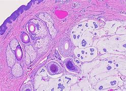 Image result for Intraorbital Skin Mucinous Carcinoma