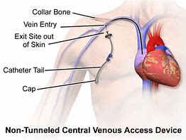 Image result for Tunnelled Central Venous Catheter