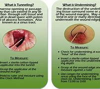 Image result for Foot Wound Measurements Undermining