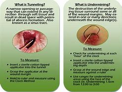 Image result for Undermining Wound Black Skin