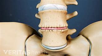 Image result for Lumbar Spine Disc Degeneration