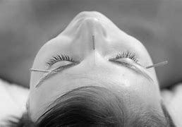Image result for Acupuncture Face Lift