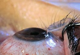 Image result for Laser Eye Surgery Clip Art