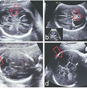 Image result for CSP Fetal Ultrasound