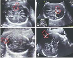 Image result for Fetal Abnormalities