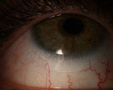 Image result for Toric Notch Contact Lens