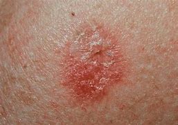 Image result for Skin Cancer Rash