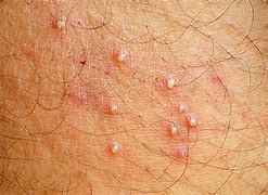 Image result for Folliculitis On Groin