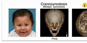 Image result for Craniosynostosis