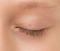 Image result for Wart On Chin