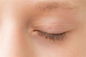 Image result for Clear Warts On Face