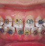 Image result for Black and Pink Braces