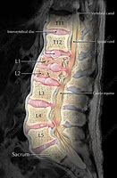 Image result for Lumbar Compression Fracture