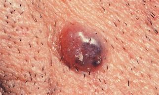 Image result for What Does Skin Cancer Pimples Look Like