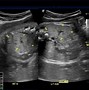 Image result for Fetal Kidneys Ultrasound
