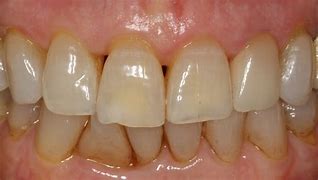 Image result for Lateral Incisor Pushed Back