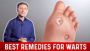 Image result for Viral Warts Treatment