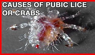 Image result for Crabs On Humans