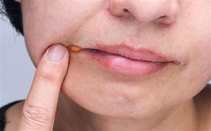 Image result for Rash On Inside of Mouth